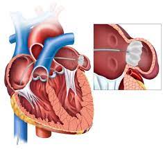 The Watchman Procedure: Redefining Stroke Risk Management post thumbnail image