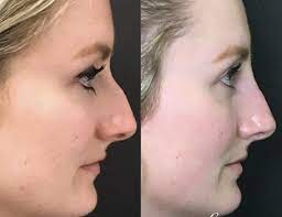 Right here, there is the best Rhinoplasty Santa Barbara doctors, the greatest in the country post thumbnail image