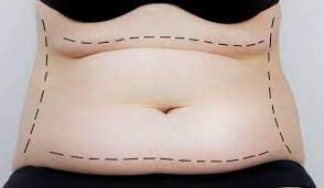 Enhance Your Figure with a Tummy Tuck in Miami post thumbnail image