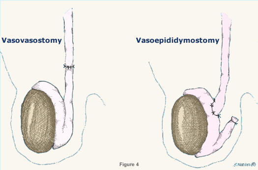 Vasectomy Reversal: Comparing Different Surgical Techniques post thumbnail image