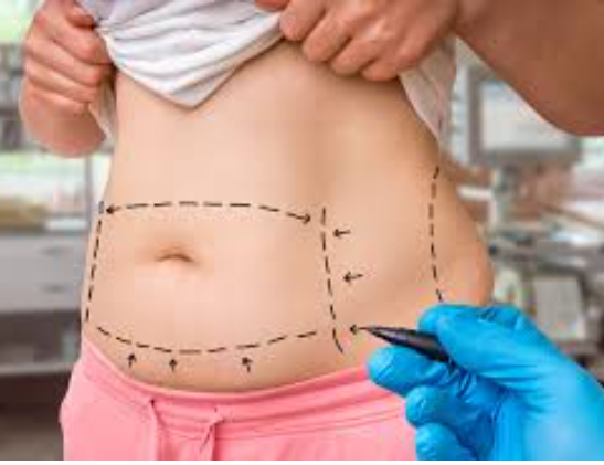 Embracing Sculpted Sophistication: The Mastery of Abdominoplasty in Miami post thumbnail image