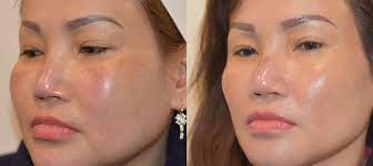 Your Journey to Youthful Skin: Botox Nearby Services post thumbnail image