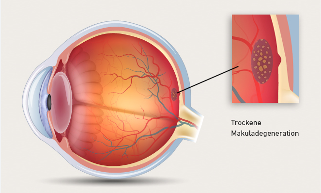 Eyes on the Future: Innovations in Macular Degeneration Research post thumbnail image