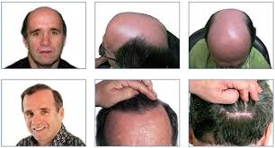 Affordable Hair Transplant Options in Toronto: Finding Your Best Fit post thumbnail image